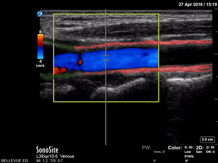 Common Carotid Long Axis - Colorized