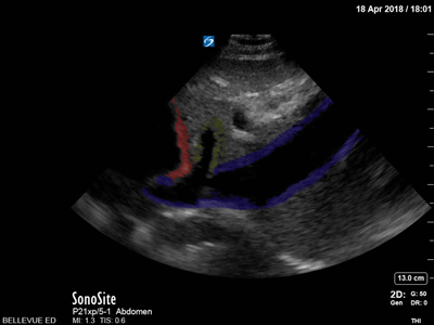 Inferior Vena Cava and Hepatic Vein - Colorized