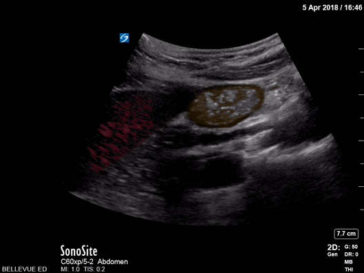 Duodenum - Colorized