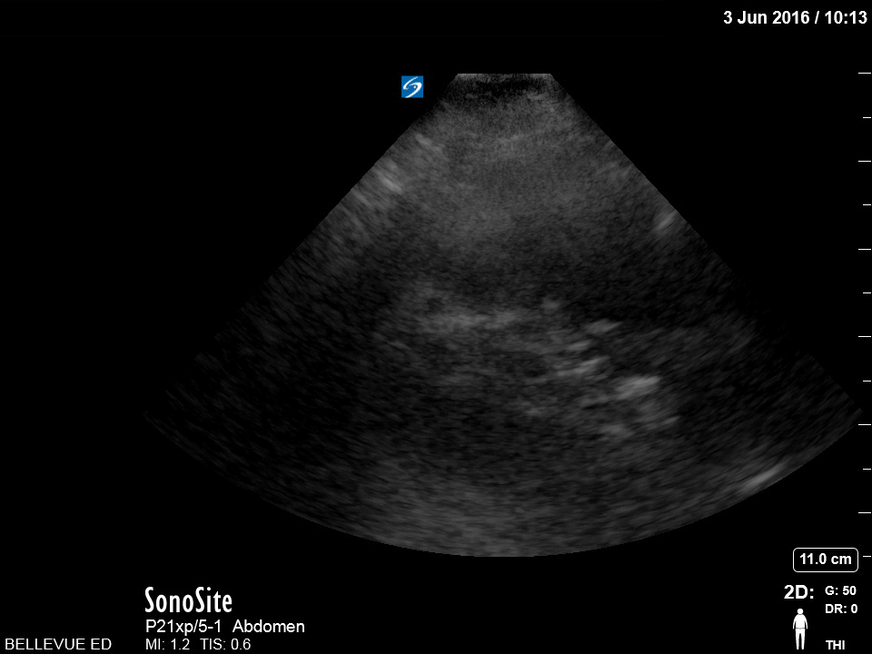 LUQ Kidney - Colorized