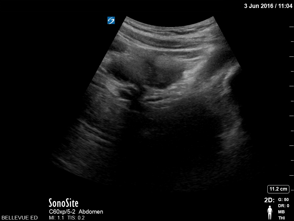 Transabdominal Uterus Sagittal View - Colorized