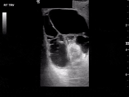 Epididymitis with Complex Hydrocele