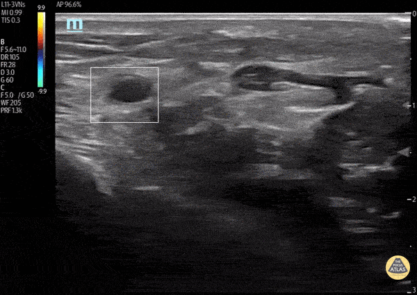 Post Arterial Catheterization Complication