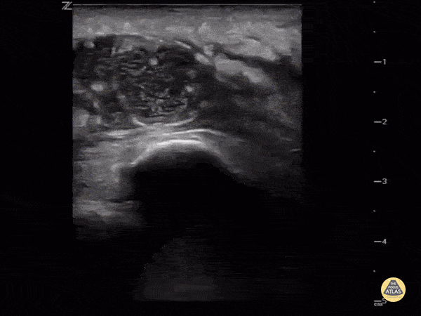 Intra-articular or extra-articular?