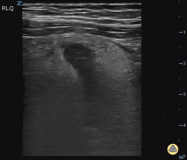 Acute Appendicitis with Appendicolith
