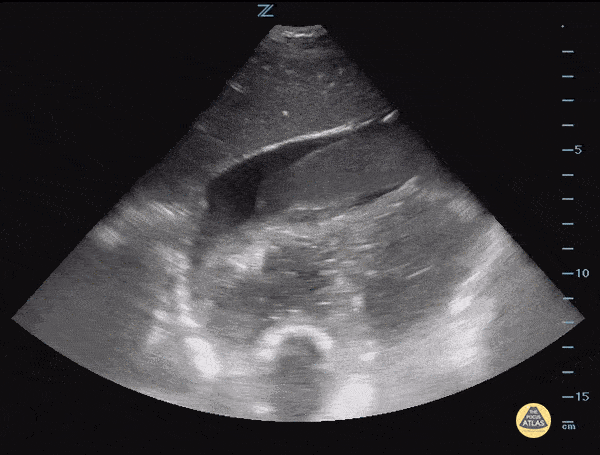 Pericardial Effusion with Hematoma