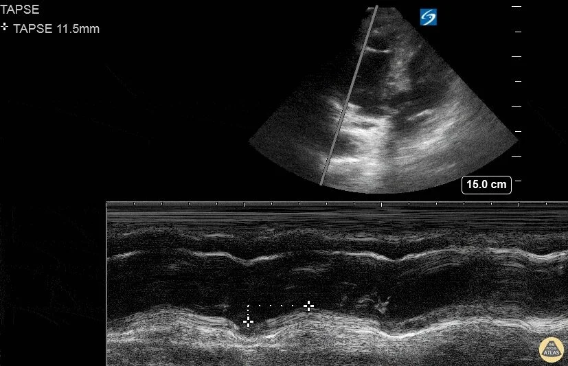 Echocardiography — TPA