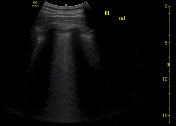 A COVID-19 Patient with 3 days of Symptoms [1/3]