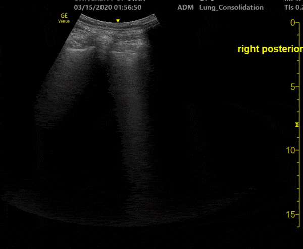 A COVID-19 Patient with 3 days of Symptoms [3/3]