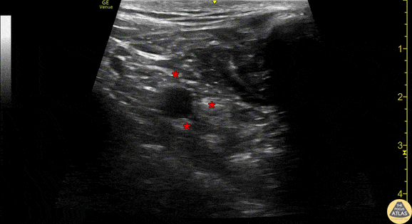 Demonstration of the anatomy of the infraclavicular brachial plexus with the linear transducer in a parasagittal orientation just lateral to the mid-clavicular line. The pulsating subclavian artery can be seen surrounded by the brachial plexus (*). The hyperechoic clavicle is seen in short axis at the right of the image. Sliding pleura can be seen deep to the artery/brachial plexus.