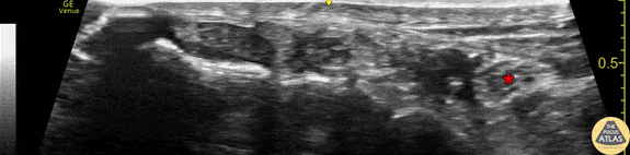 The nerve (*) is seen posterior to (right of) the pulsating posterior tibial artery. Also seen is the hyperechoic malleolar cortex of the distal tibia at the bottom of the image, as well as the tendons of tibialis posterior and flexor digitorum longus anterior to (left of) the artery and nerve. 