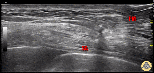 Serratus Anterior Plane Block 2