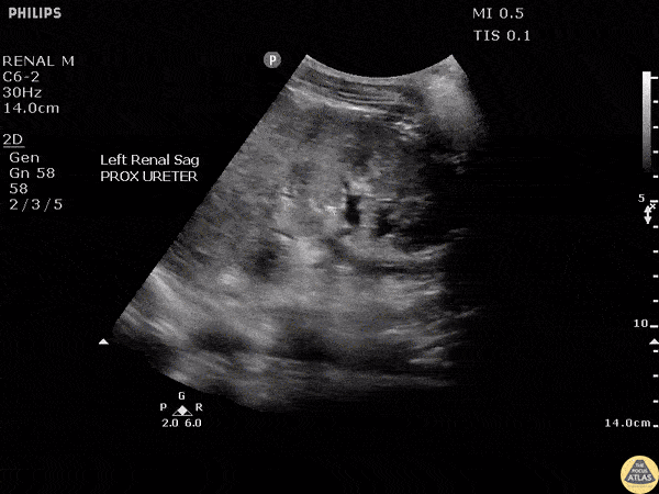 Renal/GU — TPA