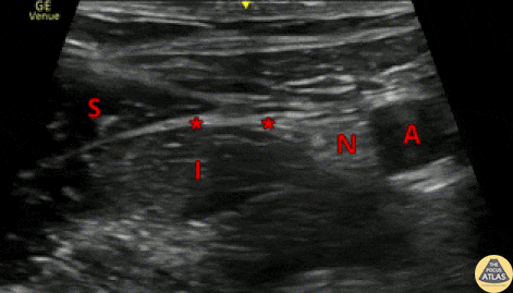 The probe marker is to the lateral aspect of the patient. The femoral nerve (N) is seen lateral to the femoral artery (A), and the sartorius muscle (S) is seen superficial to the iliacus muscle (I), with the fascia iliaca in between the two muscles. The target site for injection is just deep to the fascia iliaca, at a point lateral to the femoral nerve (*). Anesthetic should be visualized tracking medially toward the femoral nerve.