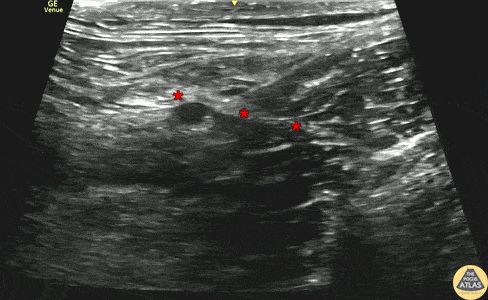 Needle entering from the lateral aspect (screen right) and depositing anesthetic just deep to the fascia iliaca (*) which lies deep to the sartorius muscle and superficial to the iliacus muscle.