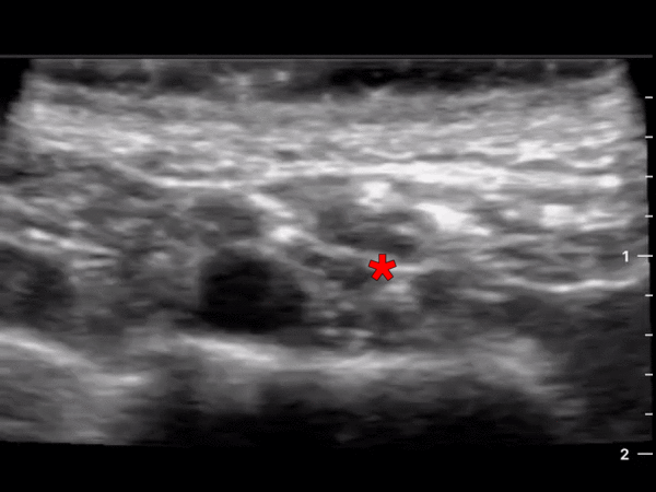The subclavian artery can be seen pulsating in the middle of the screen just superior to the hyperechoic cortex of the first rib. The * denotes the large brachial plexus bundle which can be seen just lateral to the artery.