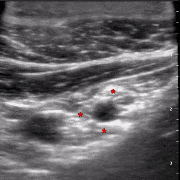 Infraclavicular Brachial Plexus Block Anatomy