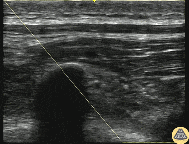 The target of anesthetic spread is the fascial plane (*) between the transverse process and the overlying erector spinae muscle.