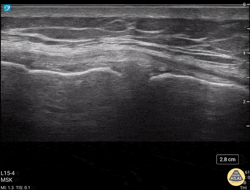 Coronal view and long axis of the MCL at the medial knee