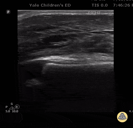 Soft Tissue Edema after Vaccination