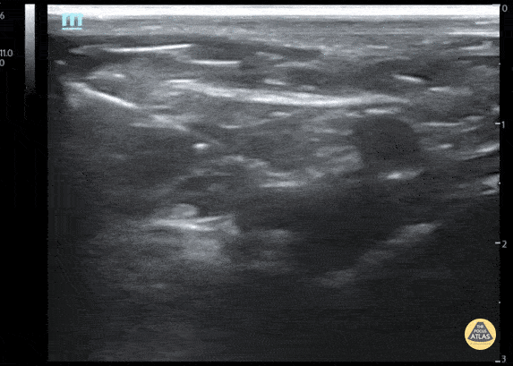 Fascia Iliaca Nerve Block