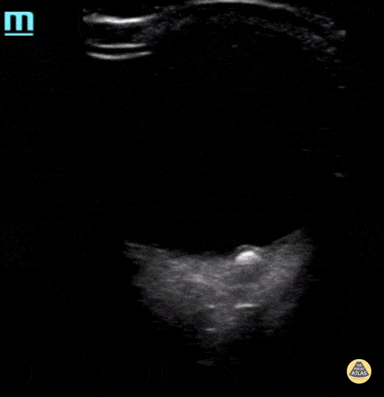 Optic Disc Drusen