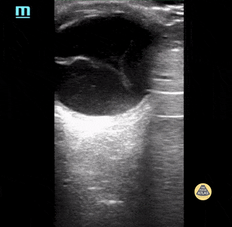 Retinal Detachment