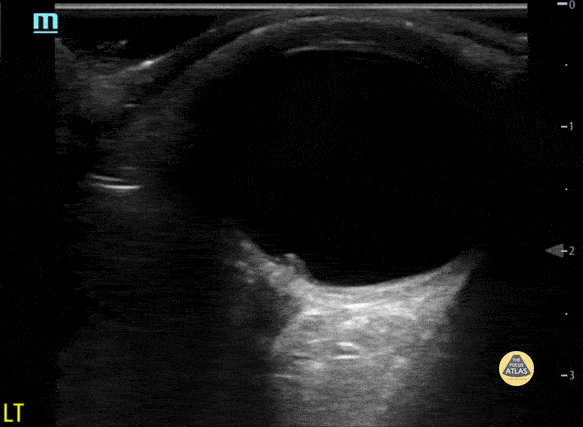 Papilledema