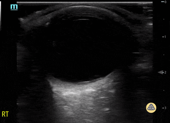 Papilledema