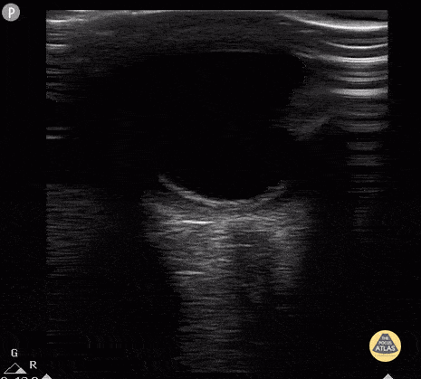 Retinal Detachment