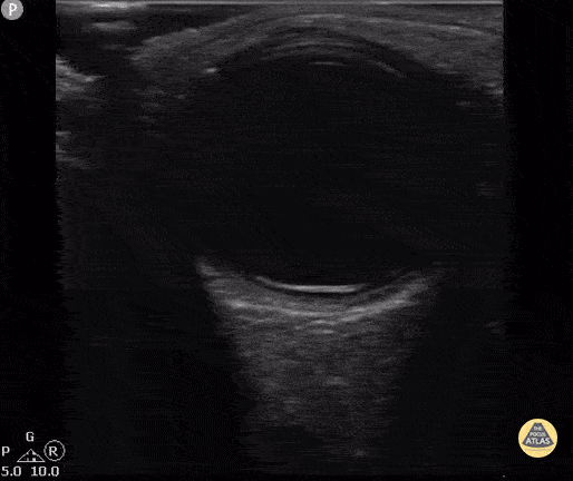 Retinal Detachment, 8 yo