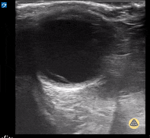 Retinal Detachment