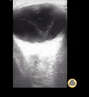Vitreous Detachment