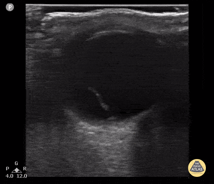 Peds-Orbital — TPA