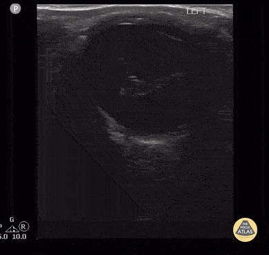 Proliferative Vitreoretinopathy 1 of 2