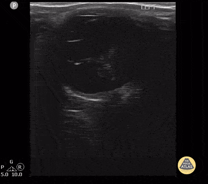 Proliferative Vitreoretinopathy 2 of 2