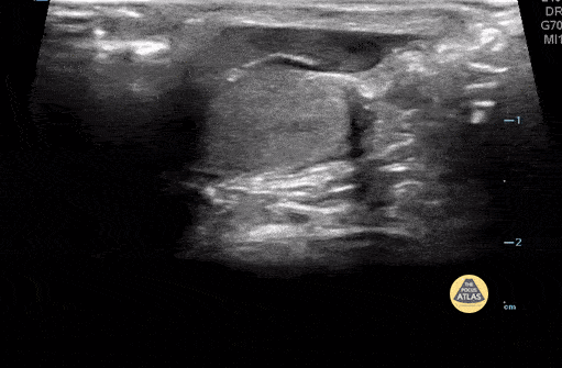 Torsion of the Appendix Testicle