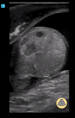 Prolonged Testicular Torsion