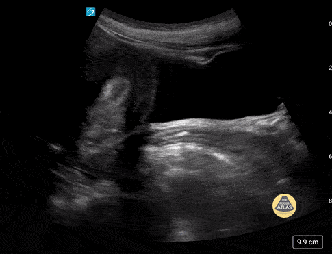 Normal Adolescent Uterus