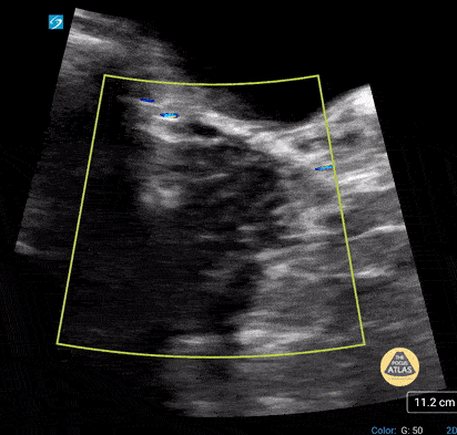 Normal Ovary
