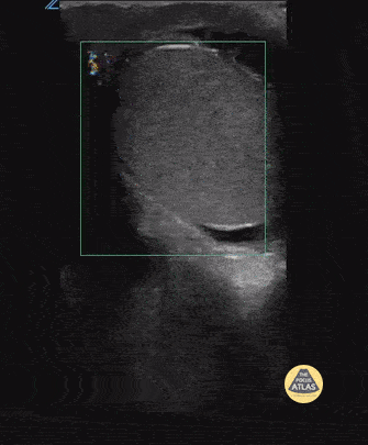 High Riding Testes Peds-Genitourinary — TPA