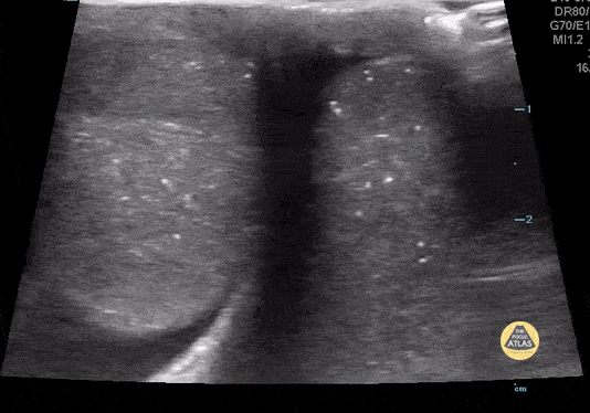 High Riding Testes Peds-Genitourinary — TPA