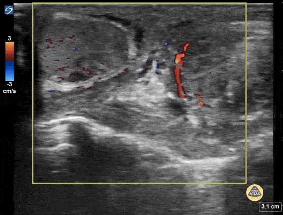 Left Sided Testicular Torsion, 15yo