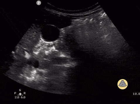 Wilm's tumor localized to right kidney Case Series 1 of 2