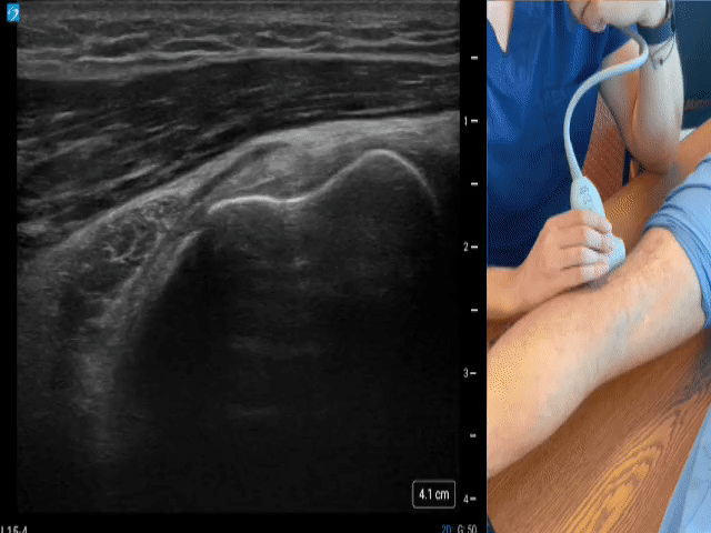 Suprapatellar/quad tendon (Short axis)