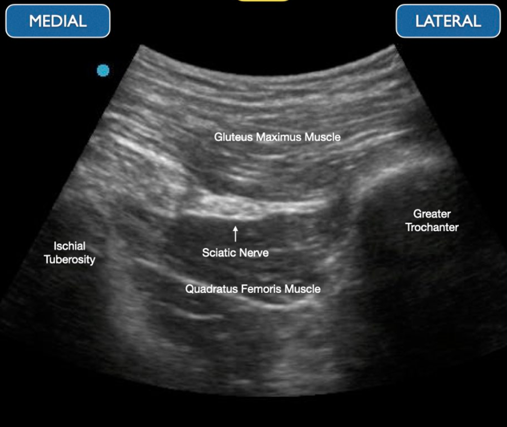 sciatic nerve block anterior approach