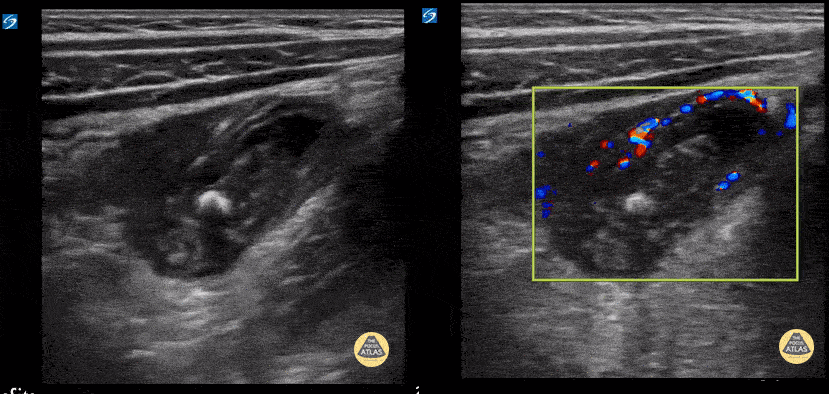 Luminal Rupture Appendix Peds-Gastrointestinal — TPA