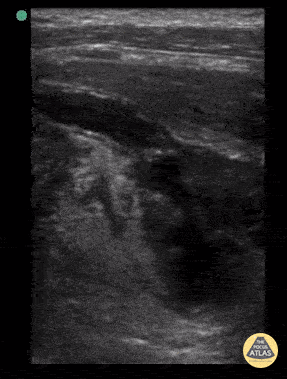 Peds-Gastrointestinal — TPA