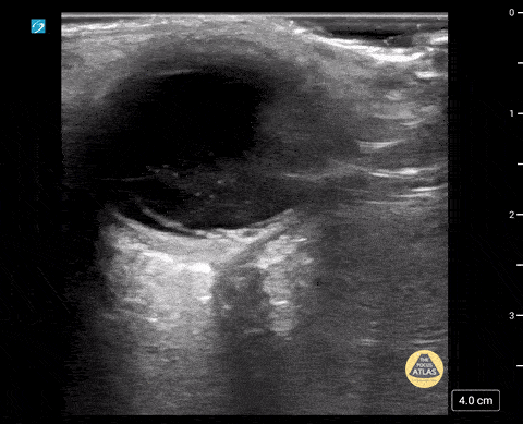 Vitreous Hemorrhage/Macular Detachment