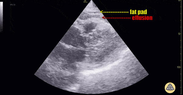Pericardial Effusion Vs Fat Pad [1/2] 